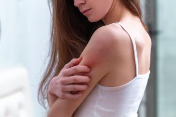 Adult-Onset Eczema