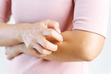 Contact Dermatitis vs Allergic Eczema image